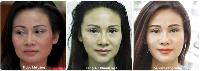 Hình ảnh khách hàng Thanh Hiền trước và sau khi căng da mặt bằng chỉ không tiêu Mỹ
