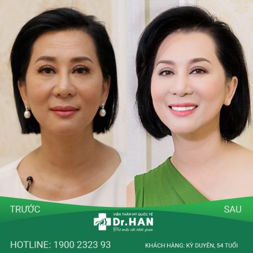 Nhan sắc xinh đẹp, trẻ tới 15 tuổi của MC Nguyễn Cao Kỳ Duyên sau kết quả thực hiện dịch vụ căng chỉ da mặt tại Dr.Han